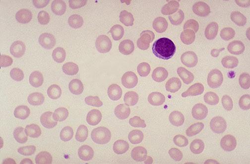 Blood Film: hypochromic microcytic erythrocytes Low