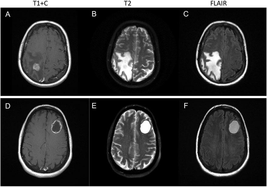 Fig. 3. A 42-year-old female with breast cancer was treated with 21 Gy in a single fraction to a right parietal brain metastasis.