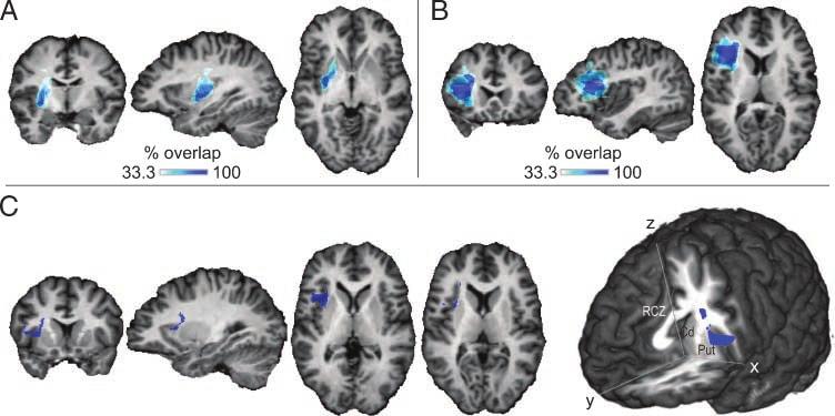 Figure 1. Lesion overlay plots. Lesions of each individual were segmented manually and overlaid on a healthy brain template after normalization to stereotactic space.