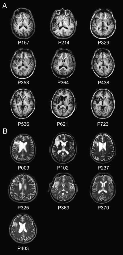 Figure 2. Representative anatomical MR slices of each patient. Anatomical convention. (A) Basal ganglia lesions, (B) lateral prefrontal cortex lesions.