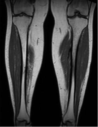 Her standing tolerance was 10 minutes and walking tolerance Figure 3: Bone scan of bilateral tibae demonstrates focal increased radiotracer uptake along the medial aspect of the left tibia at the