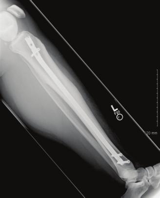placement of an intramedullary nail. mm. Of significant note is the observed deformation of the intramedullary nail after placement. Her left tibia had a Discussion valgus alignment of 6.