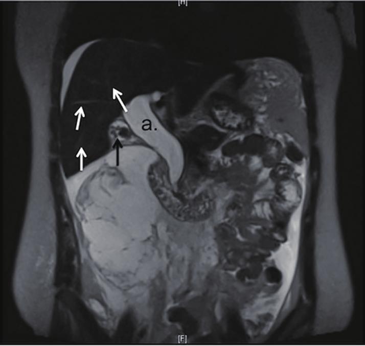 HepatoBiliary Surgery and Nutrition, Vol 4, No 1 February 2015 E9 Figure 1 CT at initial presentation in the emergency department, revealing extensive peritoneal fluid collection (white arrows).