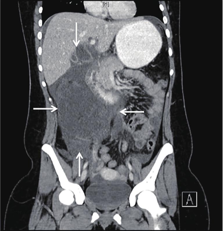 Figure 2 MRCP revealing cystic dilatation of the common bile duct with distal tapering (a), a contracted gallbladder with cholelithiasis (black arrow), and a normal intrahepatic biliary tree (white