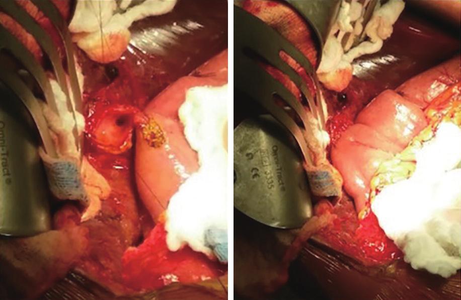 Exploratory laparotomy revealed small collections of bile around the percutaneous drains. The cyst was identified and no other areas of abnormality were visualized.