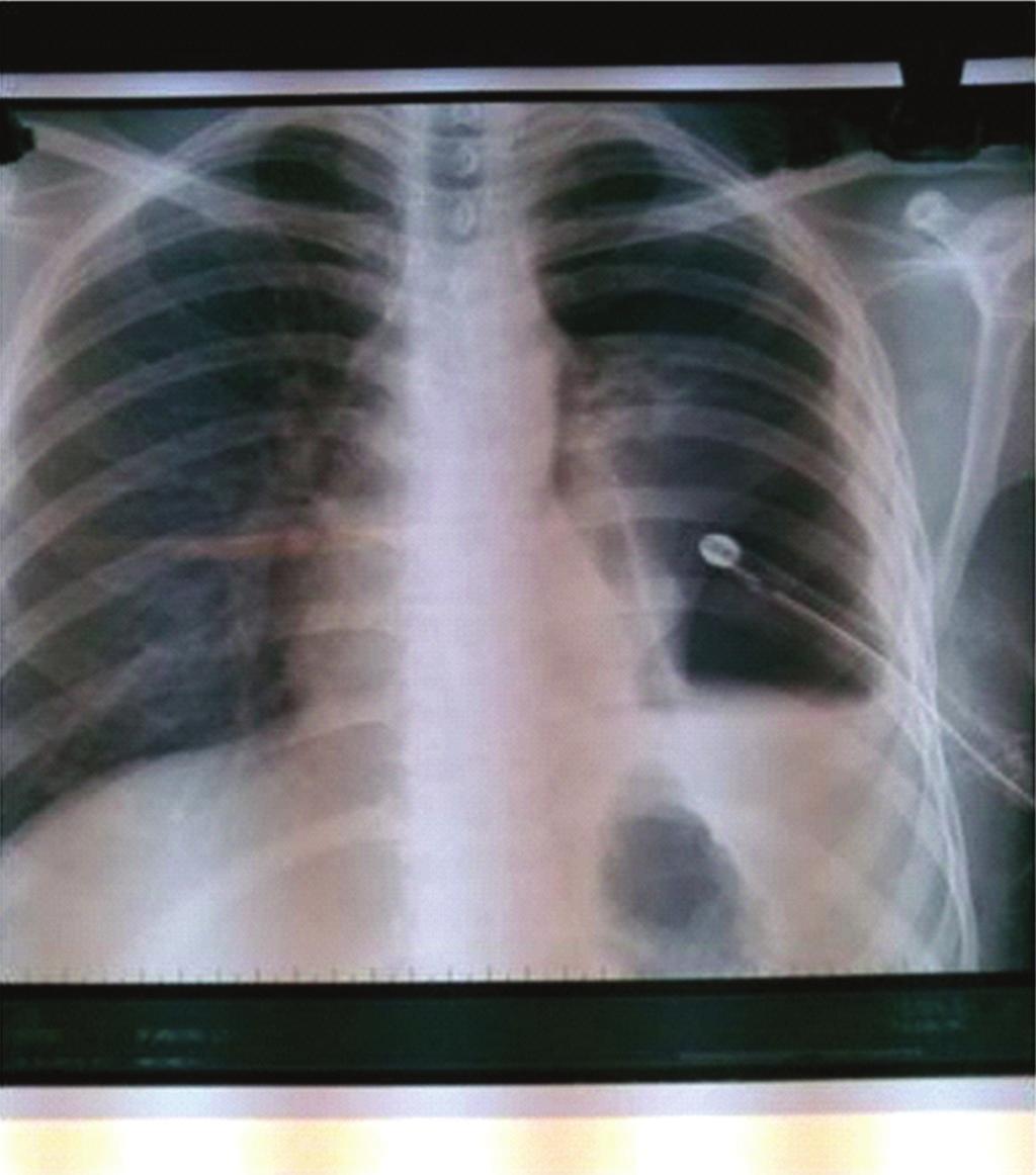 2 Case Reports in Surgery 22362 1 2 3 (a) Figure 1: Chest roentgenogram showing massive left pneumothorax (1) with collapsed left lung (2).