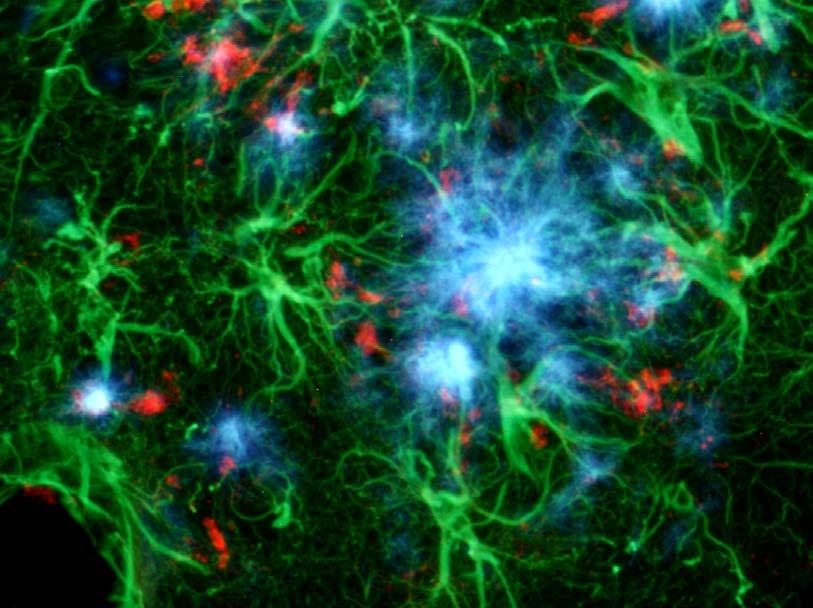 NFT Beta-amyloid Neuronal/synaptic loss Inflammatory cascade