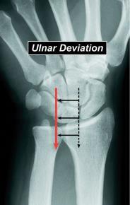 # - fracture of the distal 1/3 of the radius with