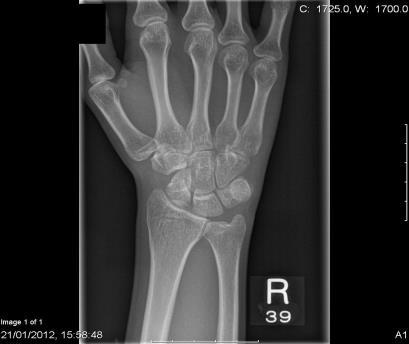 proximal row causes the ring to continue to turn the scaphoid