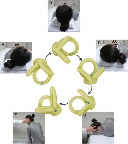 Barbeque roll (BBQ) maneuver right HC-BPPV first turning the head toward the effected ear (A), then 270 toward the unaffected side through a series of 90 steps (B-D)