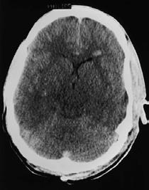 Normal Such patients often have advanced symptoms as a result of brain edema.