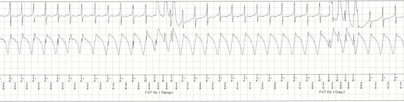 defined as the occurrence of 3 or more distinct VT episodes in a