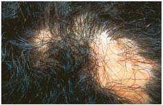 208 AN ATLAS OF HAIR PATHOLOGY Figure 22.1 Typical lesion of Brocq s alopecia in a woman whose hairdresser discovered the bald spot.