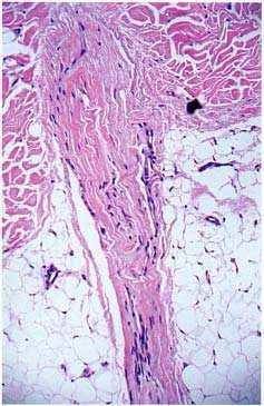 212 AN ATLAS OF HAIR PATHOLOGY Figure 22.6 Higher power view of the follicular scar shown in Figure 22.5.