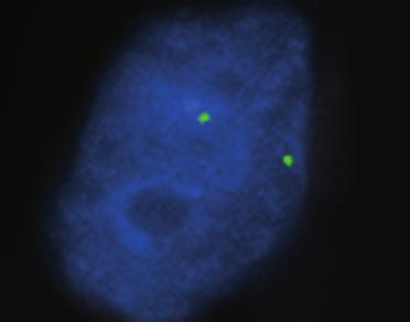 Three green signals (one out of focus) indicate the presence of three copies of chromosome 17.