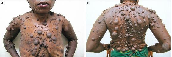 Neurofibromatosis type1 A syndrome caused by neurogenic tumors arising from neural sheath cells located along peripheral and cranial nerves.