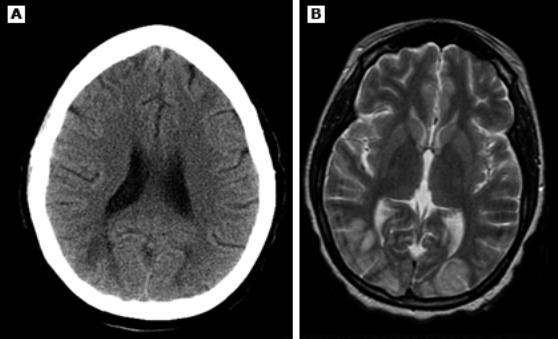 "REVERSIBLE POSTERIOR LEUKOENCEPHALOPATHY SYNDROME" CT - hypodensity in the