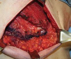 AlloMax Surgical Graft dermal implant.