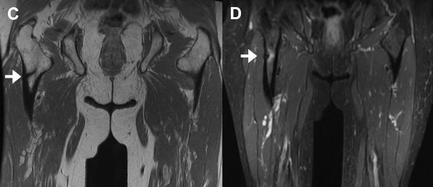 Companion Pt #1: MRI Findings Incomplete Fx Coronal MRI T1 Coronal MRI T2 Fx line extending through cortex Bone marrow edema