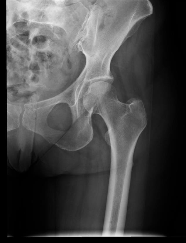 Our Patient: Plain Film Findings Unlabeled Two months prior to acute thigh pain, pt had hip plain films for nagging