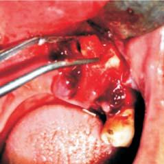 This feature differentiates this lesion 3 from condensing osteitis and idiopathic osteosclerosis.