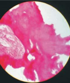 A B Figure 6: H&E (4x and 40x) Stained section shows hard tissue interspersed within the connective tissue stroma.