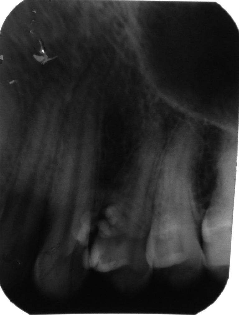 apically on the gingiva in the same region. No significant changes were noted on the surrounding mucosa (figure 5).