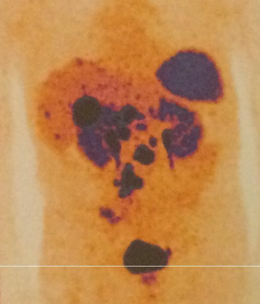 lesion), with multiple liver and lymph node metastasis June 2016: Cromogranin A >300nmol/L