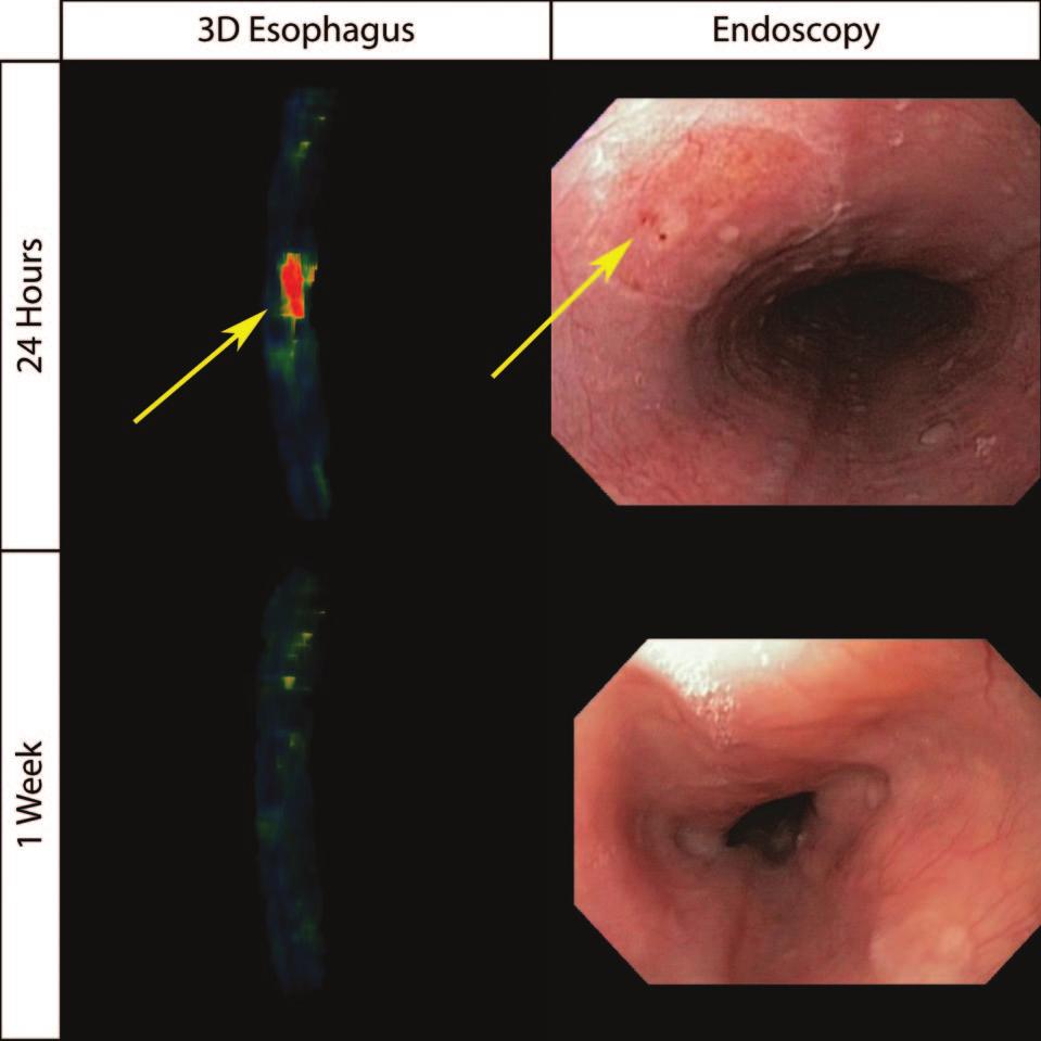 Badger et al Assessing Esophageal Tissue Injury and Recovery 623 24-hour postablation scans (P 0.06), 24-hour and 3-month scans (P 0.78), or preablation and 3-month scans (P 0.48).
