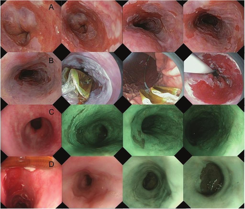 Simplified circumferential balloon-based RFA Figure 3: A-B: Baseline C3M10 Barrett s esophagus after ER (T1m3 carcinoma) treated with the simplewith-cleaning regimen for circumferential