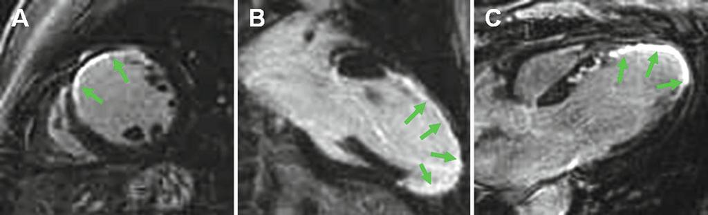 ( b ) A week later, there has been resolution of late gadolinium enhancement on MRI ( arrows ) and resolution of the lesion on EGD ( d and e ) Fig. 2.