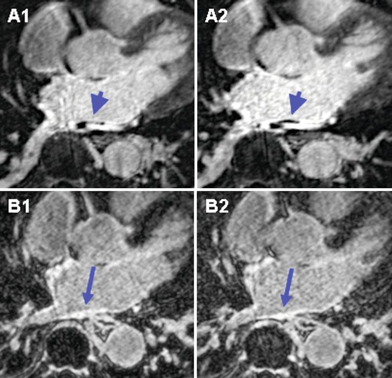 44 G.R. Vergara and N.F. Marrouche Fig. 2.6 Non-refl ow phenomenon on LGE-MRI.