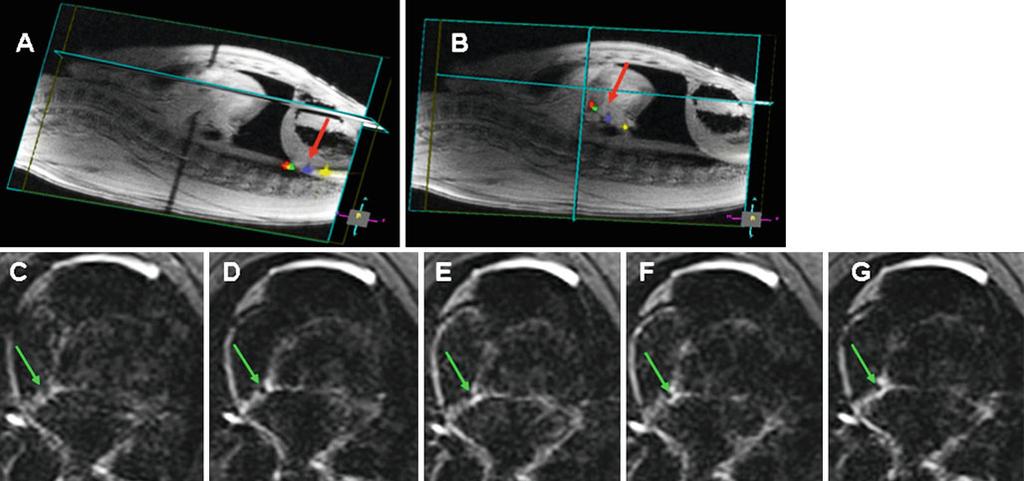 2 Magnetic Resonance Imaging: Description of Technology and Protocols 45 Fig. 2.7 Real-time MRI ablation and lesion visualization at 3-T.
