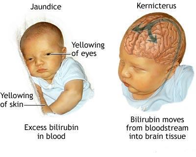 Neonatal jaundice Physiologic jaundice of the newborn Is relatively common, particularly in