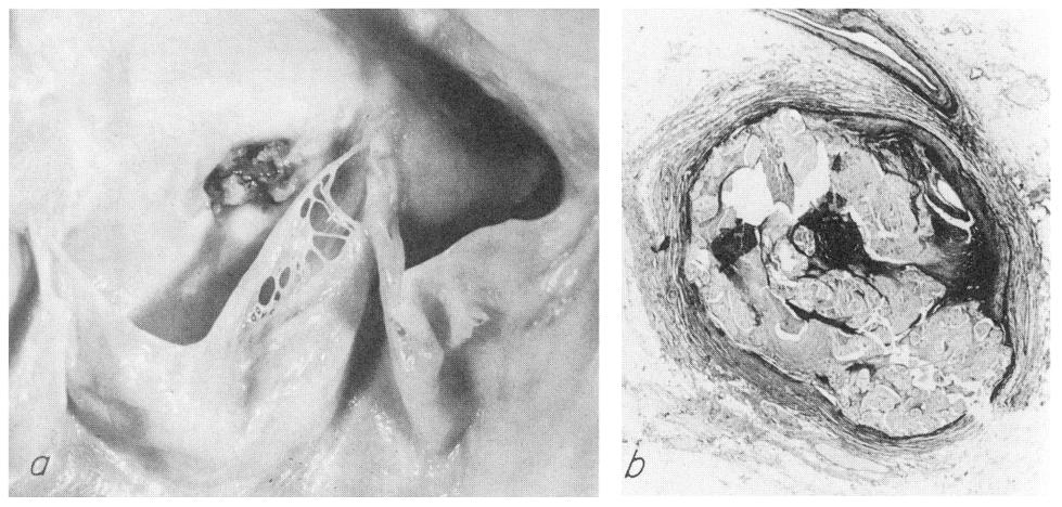 In the left half of the illustration is an encapsulated lesion formed by amorphous masses like those in the calcified aortic sinotubular ridge, as well as in the calcified aortic valve from which a