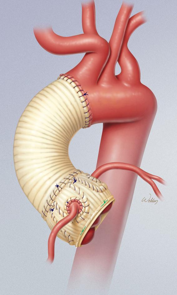 Aortic Root Replacement: Valve-sparing