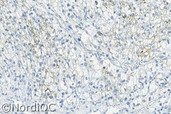 Fig. 4a Fig. 4b Optimal Ep-CAM staining of the renal cell carcinoma no.