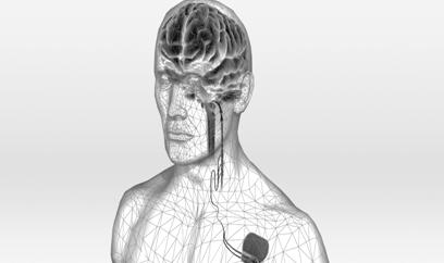 Neurostimulation for Epilepsy Responsive Neurostimulation (RNS) Trial Currently FDA trial ongoing at Rush Sponsored by Neuropace Stimulation of the Anterior Nucleus of the Thalamus for Epilepsy