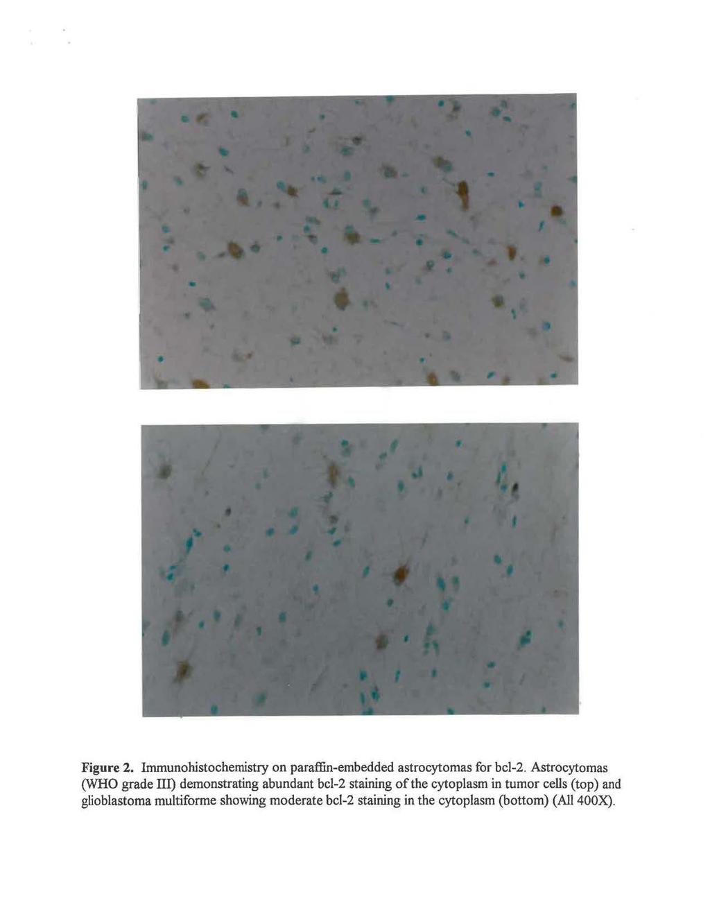 Figure 2. Immunohistochemistry on paraffin-embedded astrocytomas for bcl-2.