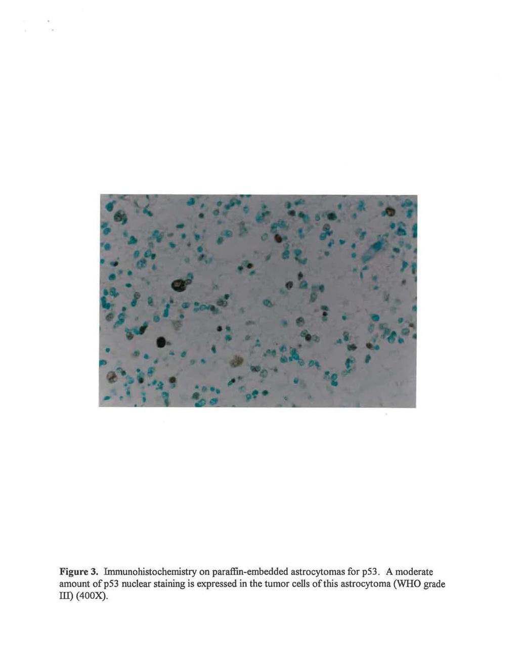 Figure 3. Immunohistochemistry on paraffin-embedded astrocytomas for p53.