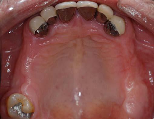 Preoperative mandibular arch demonstrating Kennedy Class II Modification I with severe attrition of mandibular anterior teeth.