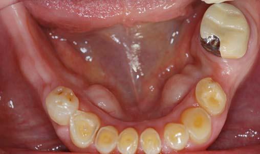 Second, interim and permanent ORPDs are often prescribed to patients with severe dental and skeletal malocclusion [13-20].