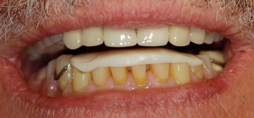 prior to initiation of definitive cast partial dentures to determine if patient comfortable with the increased VDO.