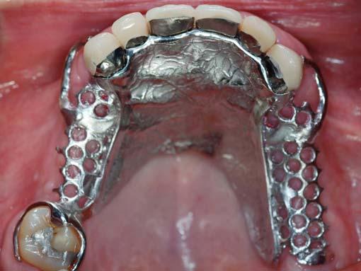216 The Open Dentistry Journal, 2009, Volume 3 Patel and Bencharit Fig. (12). Final prostheses in MIP. Fig. (9).