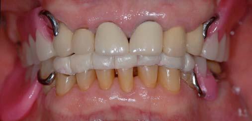Note that tooth color acrylic resin was used in the anterior portion of the mandibular interim denture.