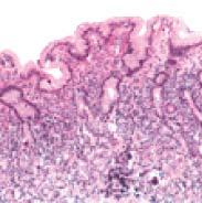 autoimmune gastritis. Metaplastic changes in the antrum and corpus are staged using the OLGA system.