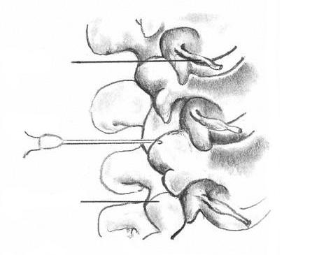 Facet joints (Also known as Zygoapophyseal joints) Facet joints are the joints between the bones in your spine (backbone).