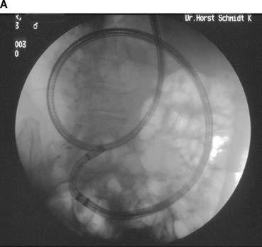 2018 May et al. procedures, as prospective studies have shown that the insertion depth is significantly greater when an overtube is used (6, 7).
