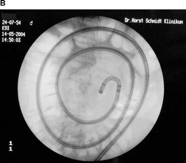 during PE (10, 11). The enteroscope is inserted as far as possible into the small bowel (Fig. 1).