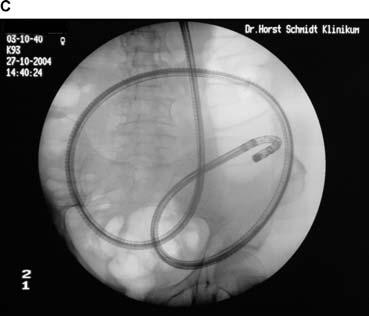 Under fluoroscopic guidance, the position of the enteroscope is checked and looping within the stomach is avoided. After straightening, the scope is pulled back until the pylorus is reached again.